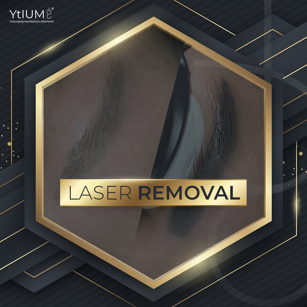Laser Removal